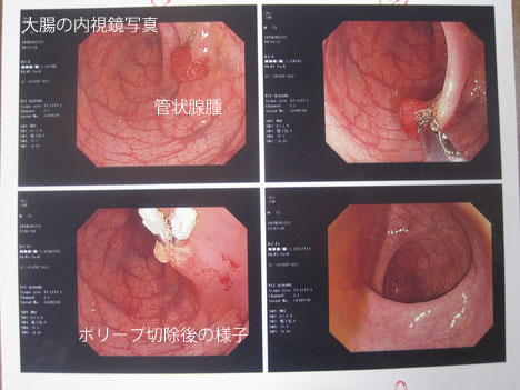 大腸の内視鏡写真