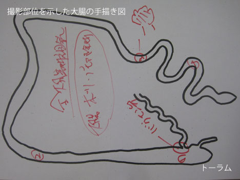 撮影部位を示した大腸の手描き図